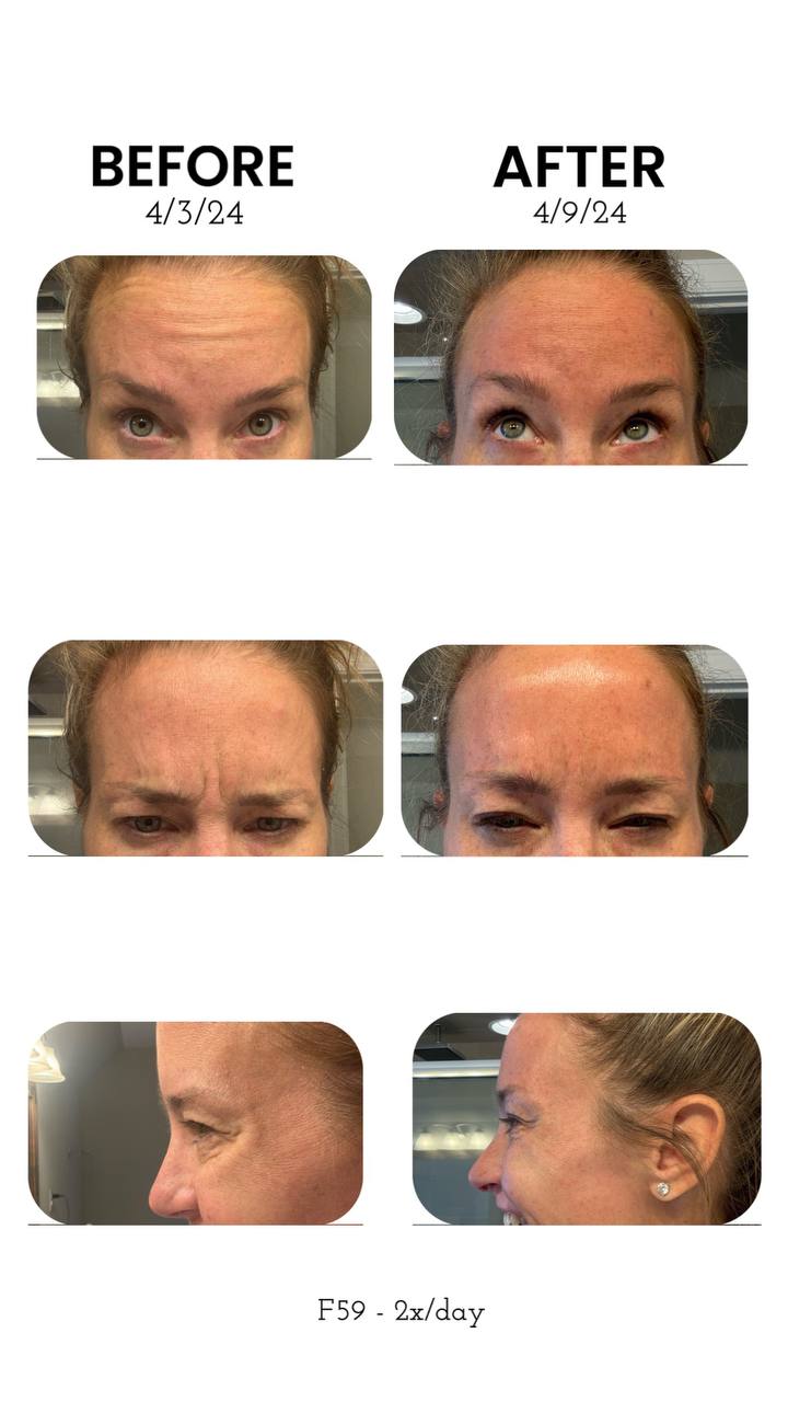 Unretouched six-day F59 forehead before-and-after: three expressions (raised brows, furrowed forehead, profile), dated April 3 and April 9, 2024, labelled F59 twice a day