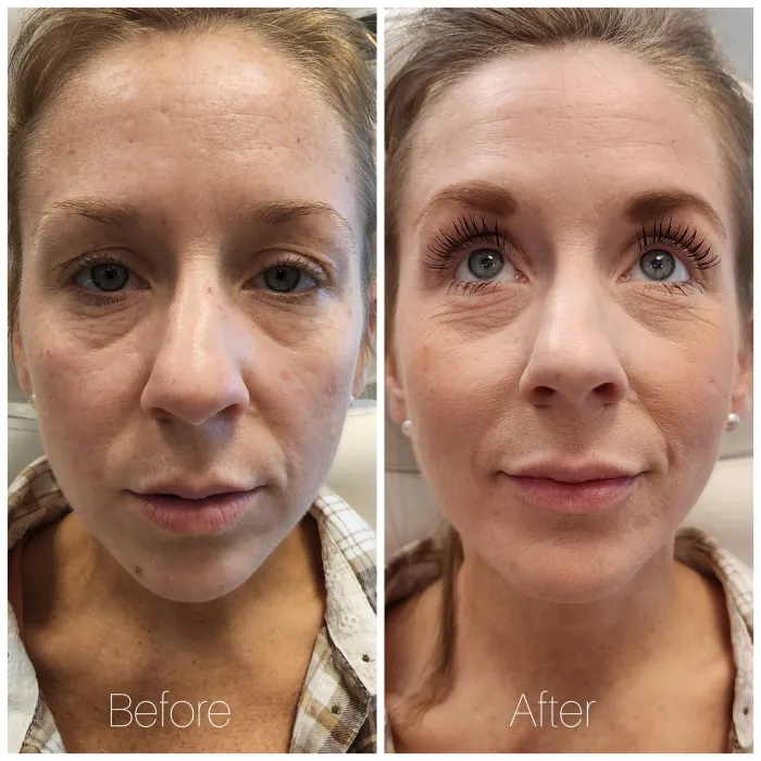 Before and after: AquaGold: under-eye skin quality