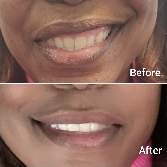 Before and after: an uneven smile from Bell’s palsy, then a balanced smile after Botox