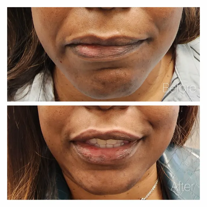 Before and after: lower face at rest affected by Bell’s palsy, then a relaxed, even smile after Botox