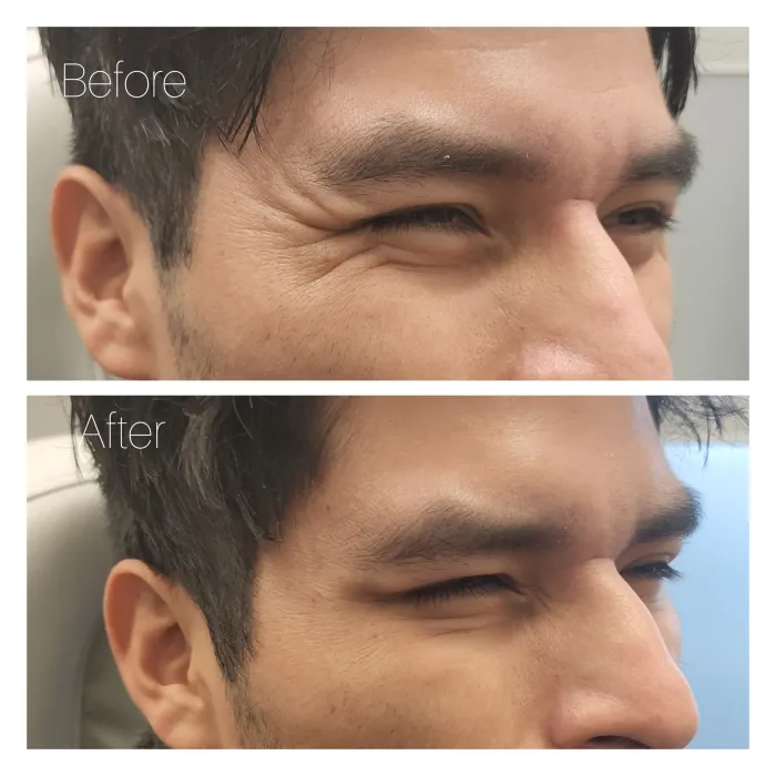 Before and after: Eye area · side angle 1
