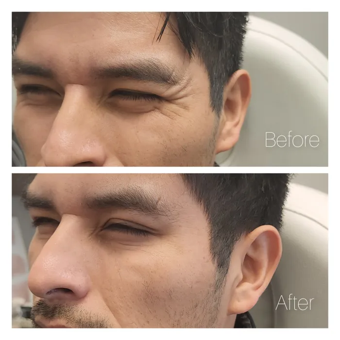 Before and after: Eye area · side angle 2