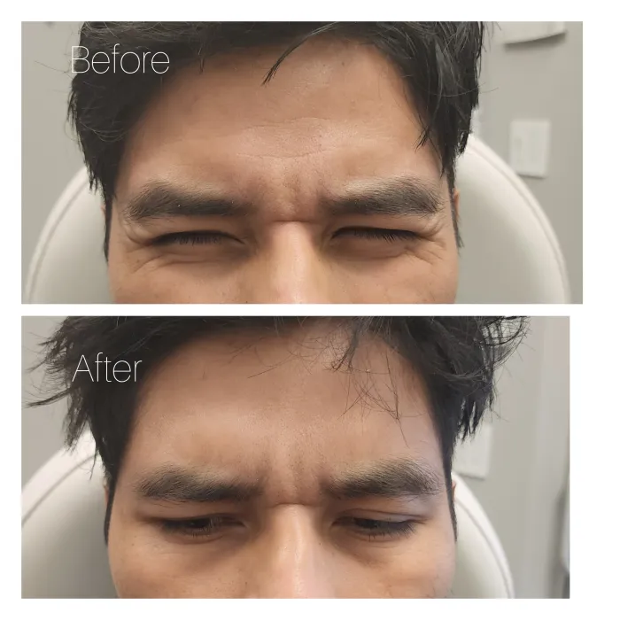 Before and after: Eye area · front squint