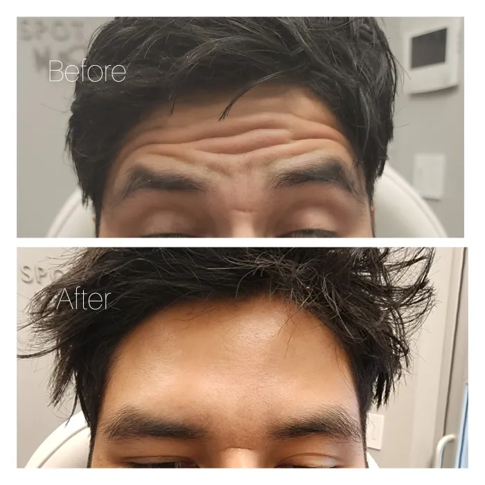 Before and after: Forehead · brows raised