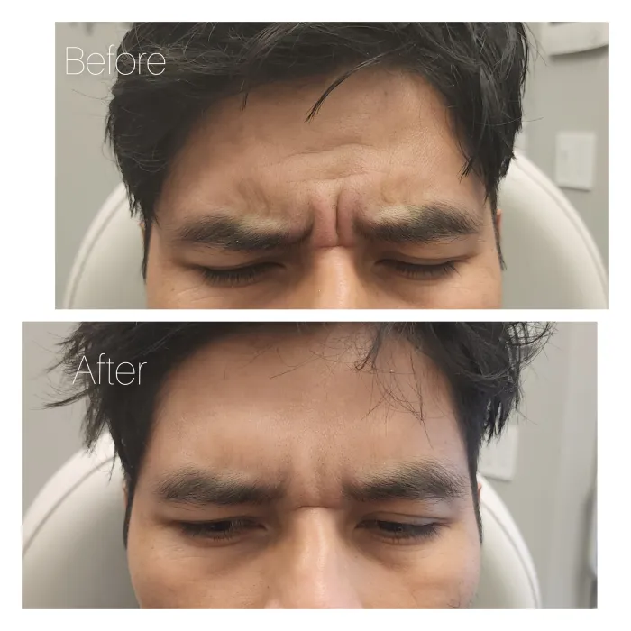 Before and after: Frown lines · brows furrowed