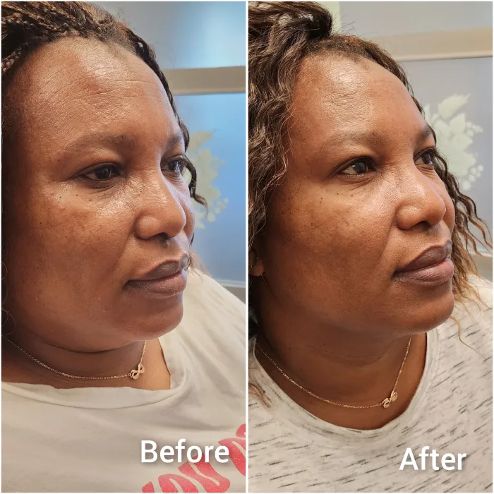Before and after: Botox lift, side view