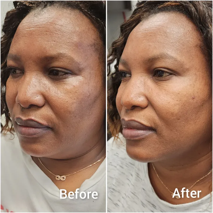 Before and after: Botox lift, three-quarter view