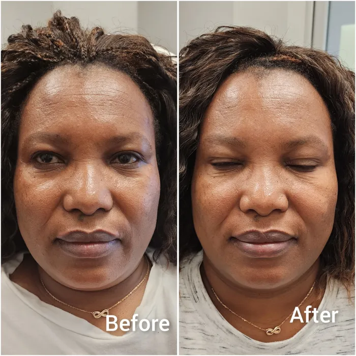 Before and after: Full-face Botox, front view