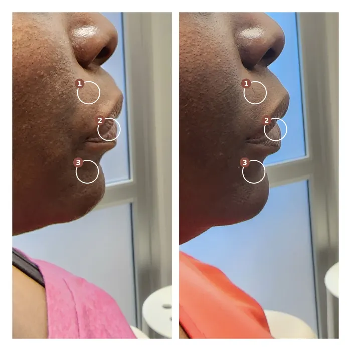 Before and after: lower face Botox, side profile, two weeks apart, with the smile line, lips and chin marked