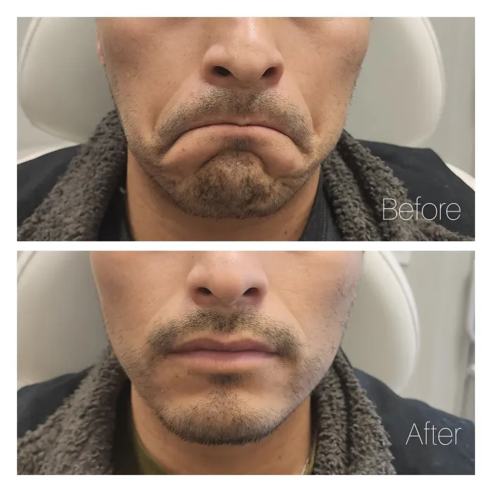 Before and after: Lower face · chin