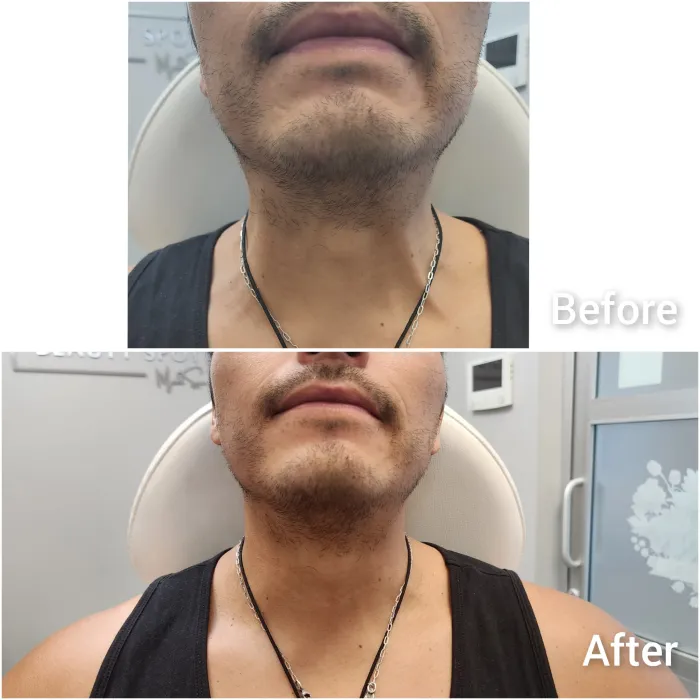 Before and after: Neck