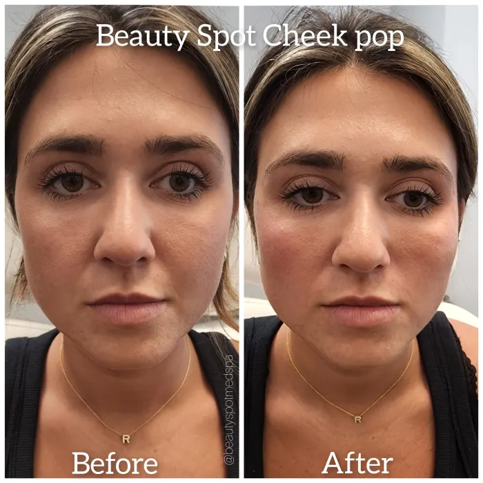 Before and after: Beauty Spot Cheek Pop, front view