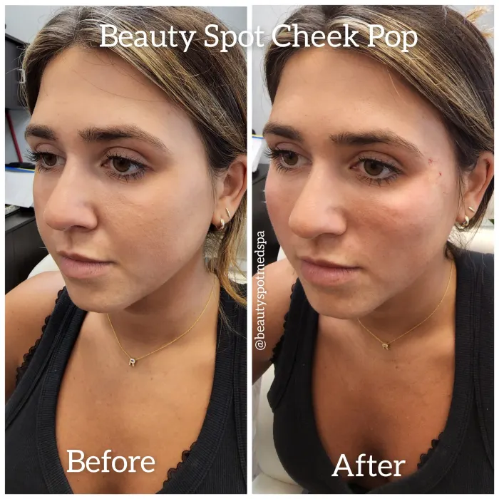 Before and after: Beauty Spot Cheek Pop, left side