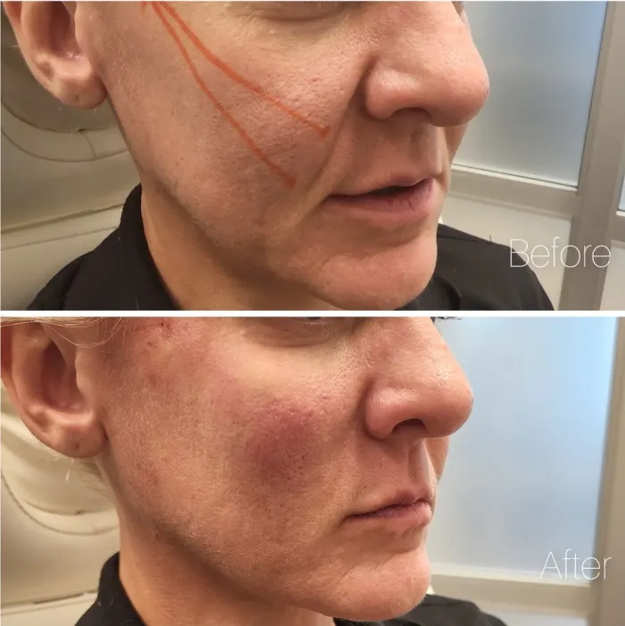 Before and after: Beauty Spot Cheek Pop, with the thread lines marked