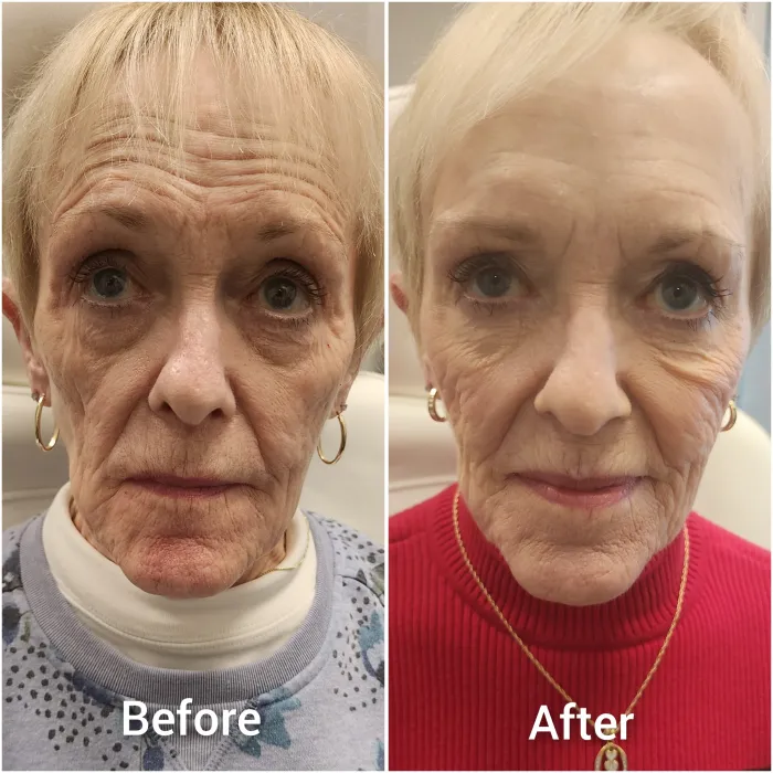 Before and after: Full-face Botox