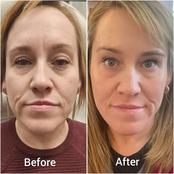 Before and after: Full-face Botox, second patient