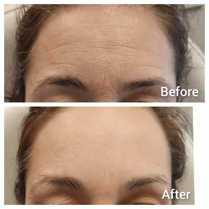 Before and after: forehead and frown lines two weeks after Botox and smooth threads