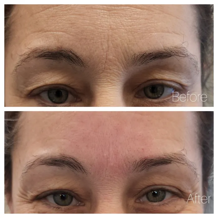 Before and after: forehead and frown lines immediately after Botox and smooth threads, with fresh redness