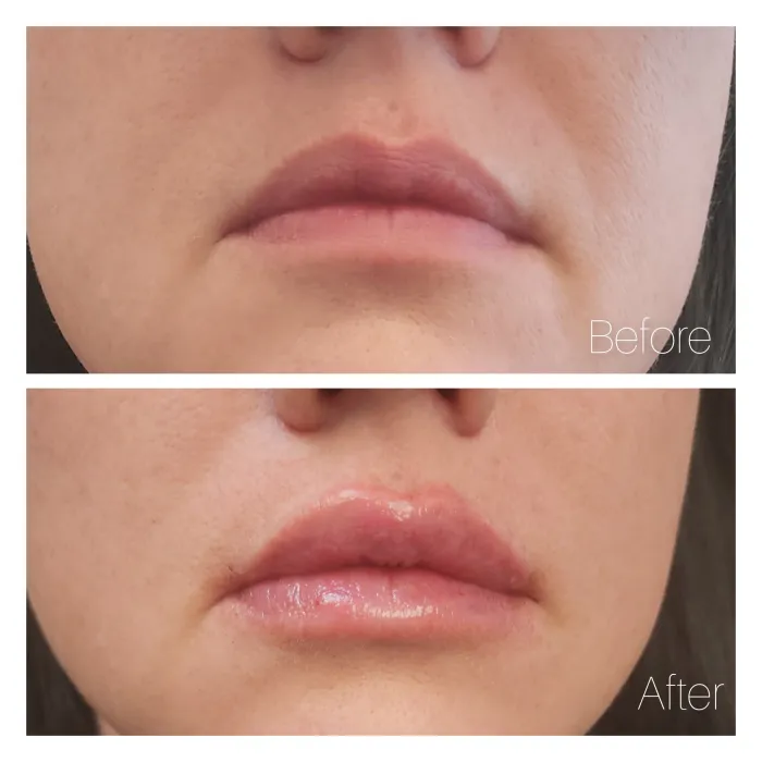 Before and after: Lip filler