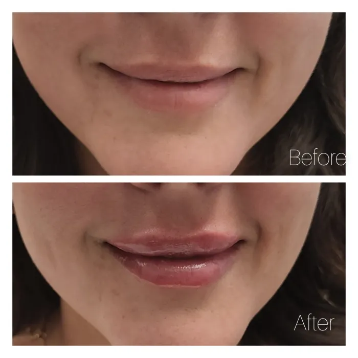 Before and after: Lip filler