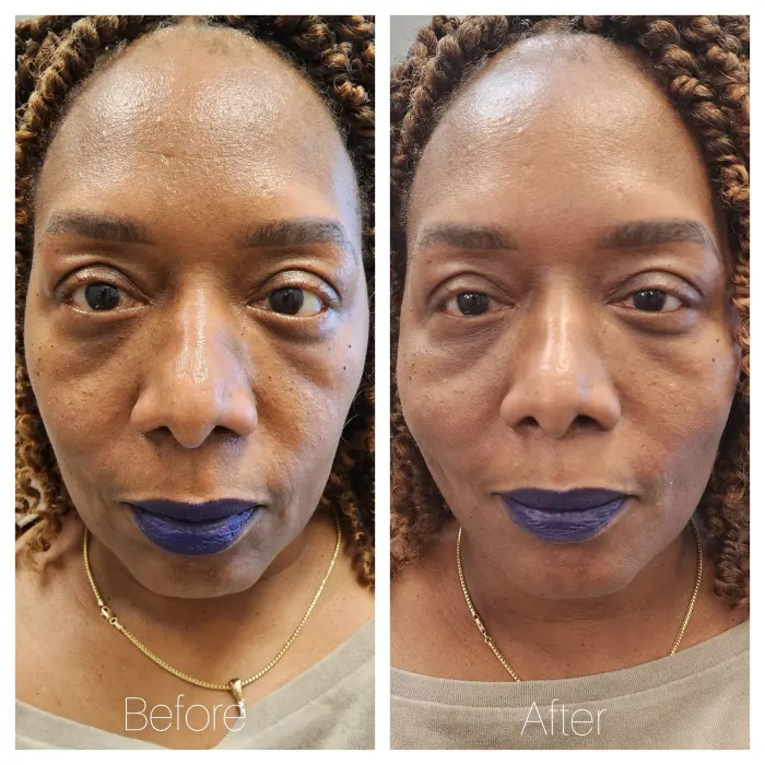 Before and after: PDO thread lift, midface and lower face, front view