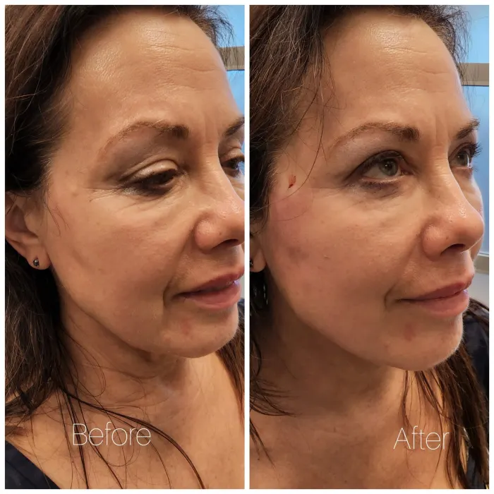 Before and after: PDO thread lift, jowls and jawline, three-quarter view