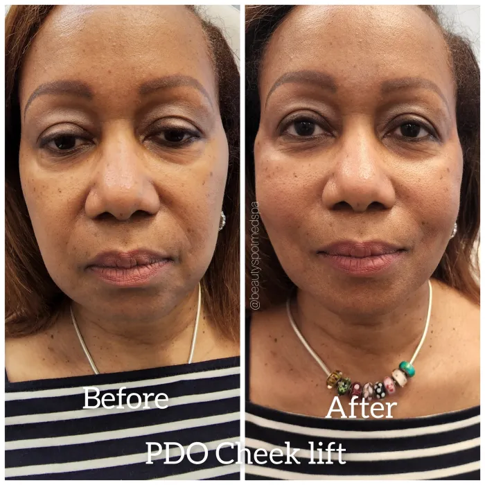 Before and after: PDO thread lift, cheek lift, front view