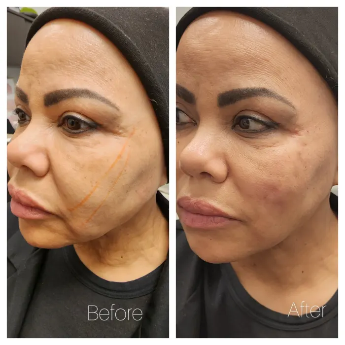 Before and after: PDO thread lift, cheek and jawline, with the thread lines marked