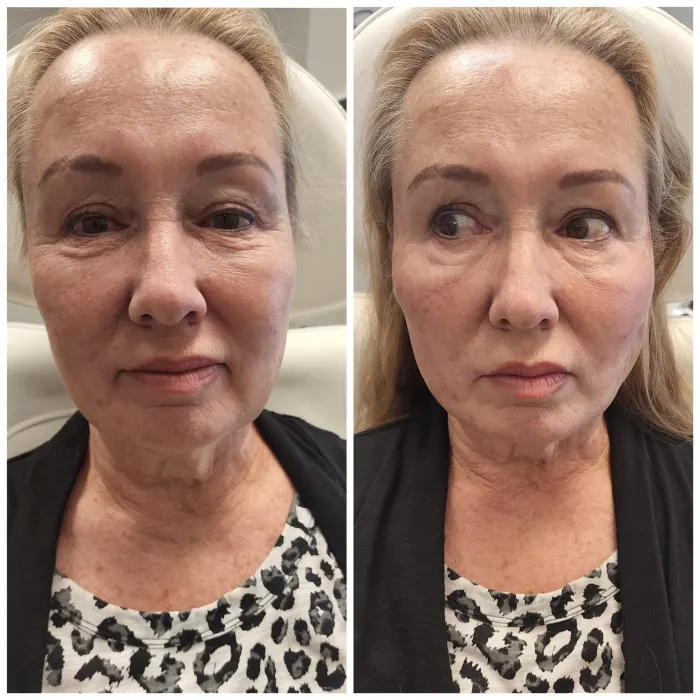 Before and after: PDO thread lift, full face, front view