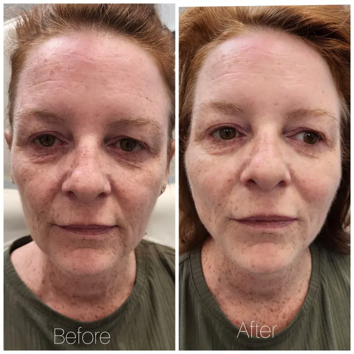Before and after: PDO thread lift, front view