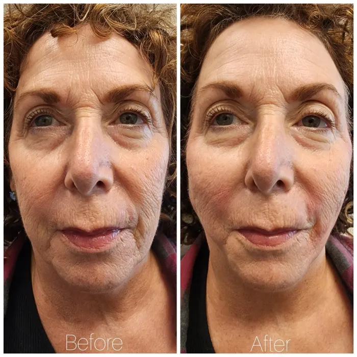 Before and after: PDO thread lift, lower face and jawline, front view