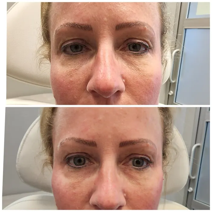 Before and after: under-eye area immediately after a PDO thread cheek lift, with no filler