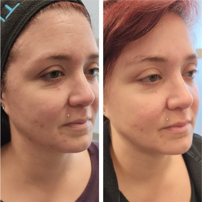 Before and after: chemical peel, Beauty Spot patient