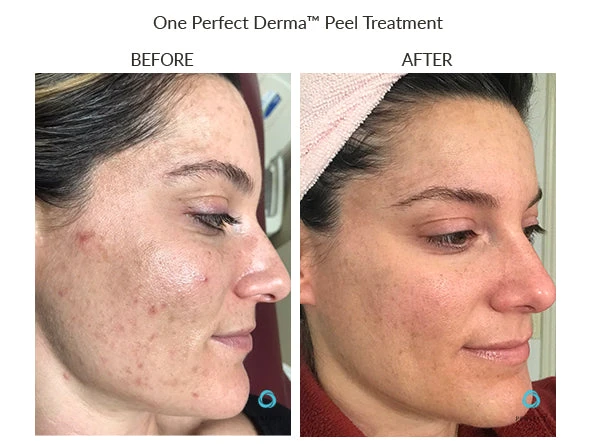 Before and after: one Perfect Derma Peel treatment, official Perfect Derma photo